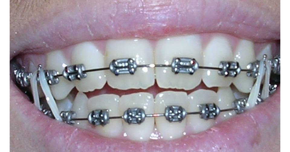 pengalaman memakai braces